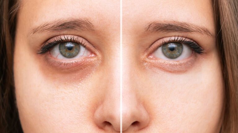 Unveiling the Mystery of Dark Circles: Expert Insights on Types and Treatments