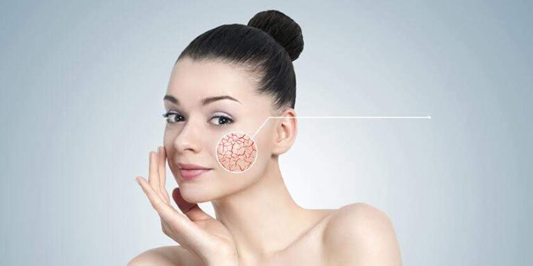 Say Goodbye to Spider Veins: Understanding and Treating Couperosis