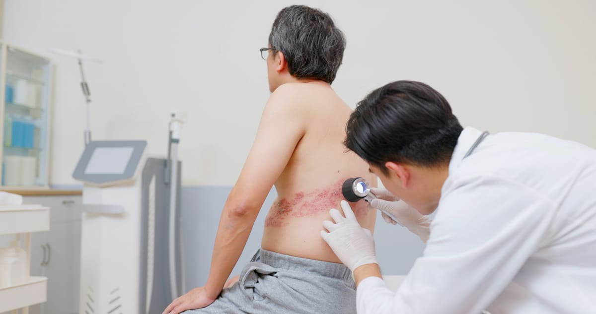 shingles rash on man