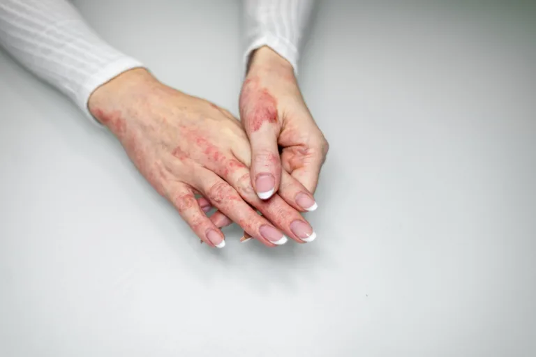 8 Best Eczema Treatments for Dry, Inflamed Skin