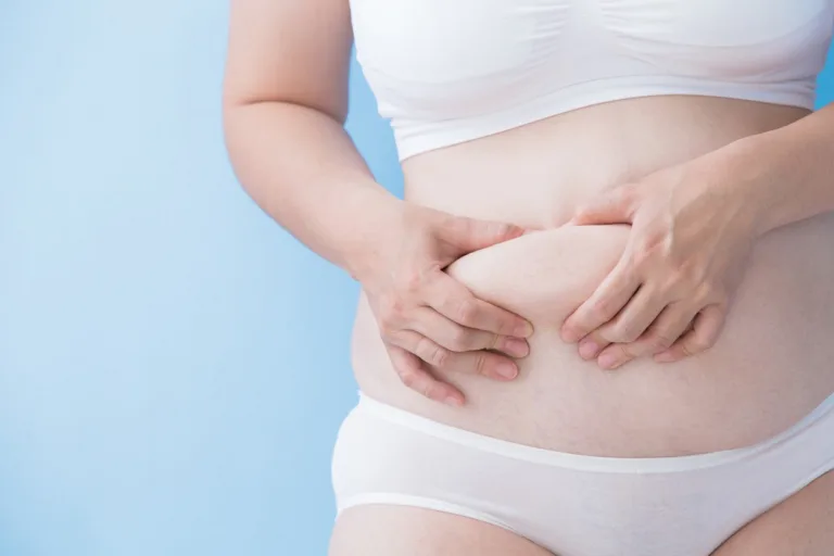 Skin Removal After Weight Loss: What You Should Know