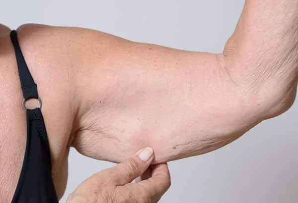 Defying Loose Skin After Weight Loss in Your 50s and Beyond