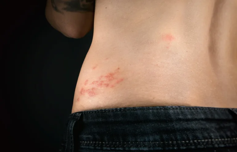 Shingles Exposed: The Painful Rash You Need to Know About
